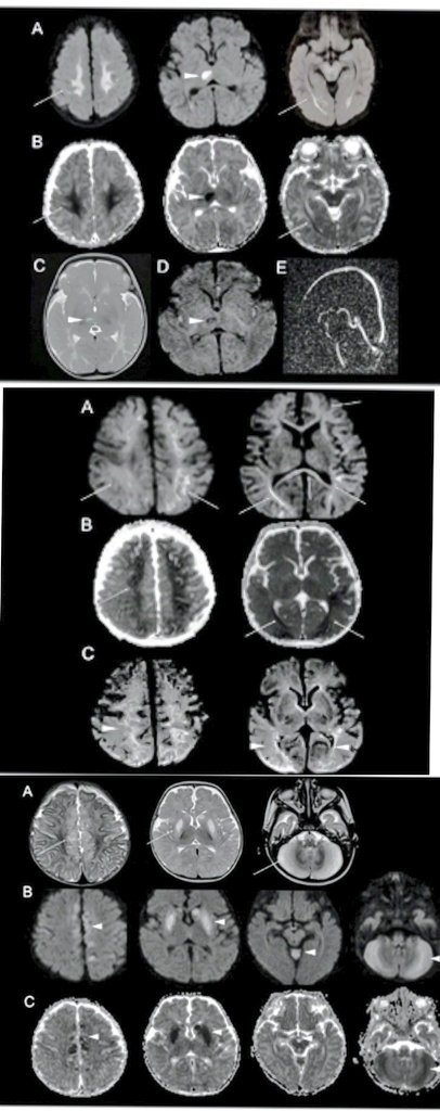 Thiamine deficiency in infants -important to diagnose & manage quickly due its treatability
TD-present with Cardiac🫀 acute life-threatening PAH crisis,severe encephalopathy alongwith typical🧠 neurological manifestaions
ejpn-journal.com/article/S1090-…
#pedineurorad #thiaminedeficiency