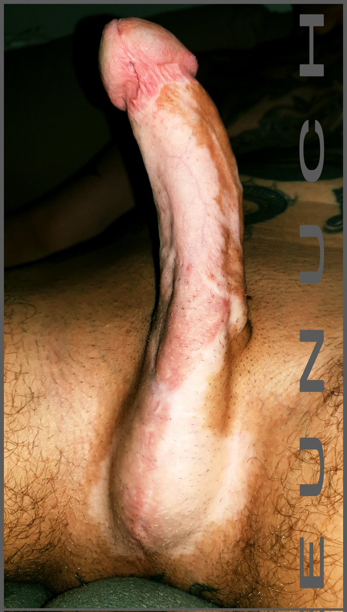 Wallach_cgn's tweet photo. unhappy-crooked-spotted-rare so hard... How many more reasons do you need to have a penctomy? Finally make space! Physically and mentally! 😩
#cutoffthisjunk #penectomy #futurenullo #rightnow https://t.co/ICOfz4h4Yy