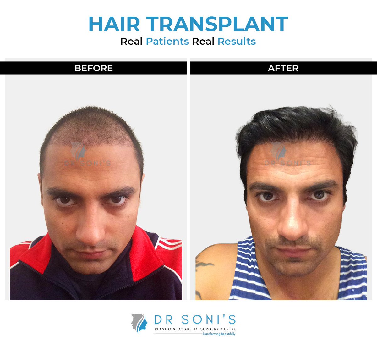 therealdrsoni's tweet photo. 1 year result of Hair Transplant patient who specially flew in from Australia to get his Hair Transplant done from us.

Method: Bio FUE Hair Transplant
Area: Front
Graft: 4000
Anesthesia💉: Local
Final Results: 9-12 months for full growth
Time taken🕛: 7-8 hours
Pain😰: No pain https://t.co/TMFfFqN6kT