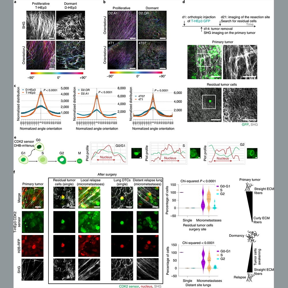 Nature Portfolio (@natureportfolio) on Twitter photo A study in <a href="/NatureCancer/">Nature Cancer</a> shows how cancer cells can remain dormant for years after they leave a tumor for other organs before forming clinically detectable metastases. go.nature.com/3yGSZu0 A study in <a href="/NatureCancer/">Nature Cancer</a> shows how cancer cells can remain dormant for years after they leave a tumor for other organs before forming clinically detectable metastases. go.nature.com/3yGSZu0