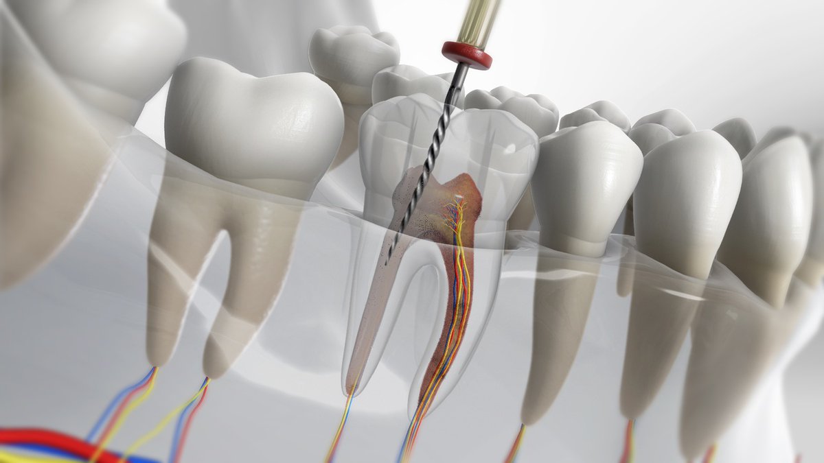 Endodontics treatment is typically needed when the #tooth nerve &amp; pulp become inflamed or infected. #Endodontics treatment are performed to save the tooth from an infection that is affecting the nerves in its root.

Book your appointment: 📞📞615-896-7582
fitzgeralddentistry.com