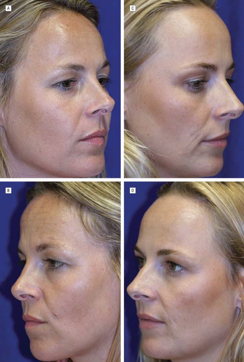 Ботокс в 30 лет. Страдальческая складка на лице. Бассейн после ботокса. От уколов ботокса растягивается ли кожа. Бассейн после ботокса.