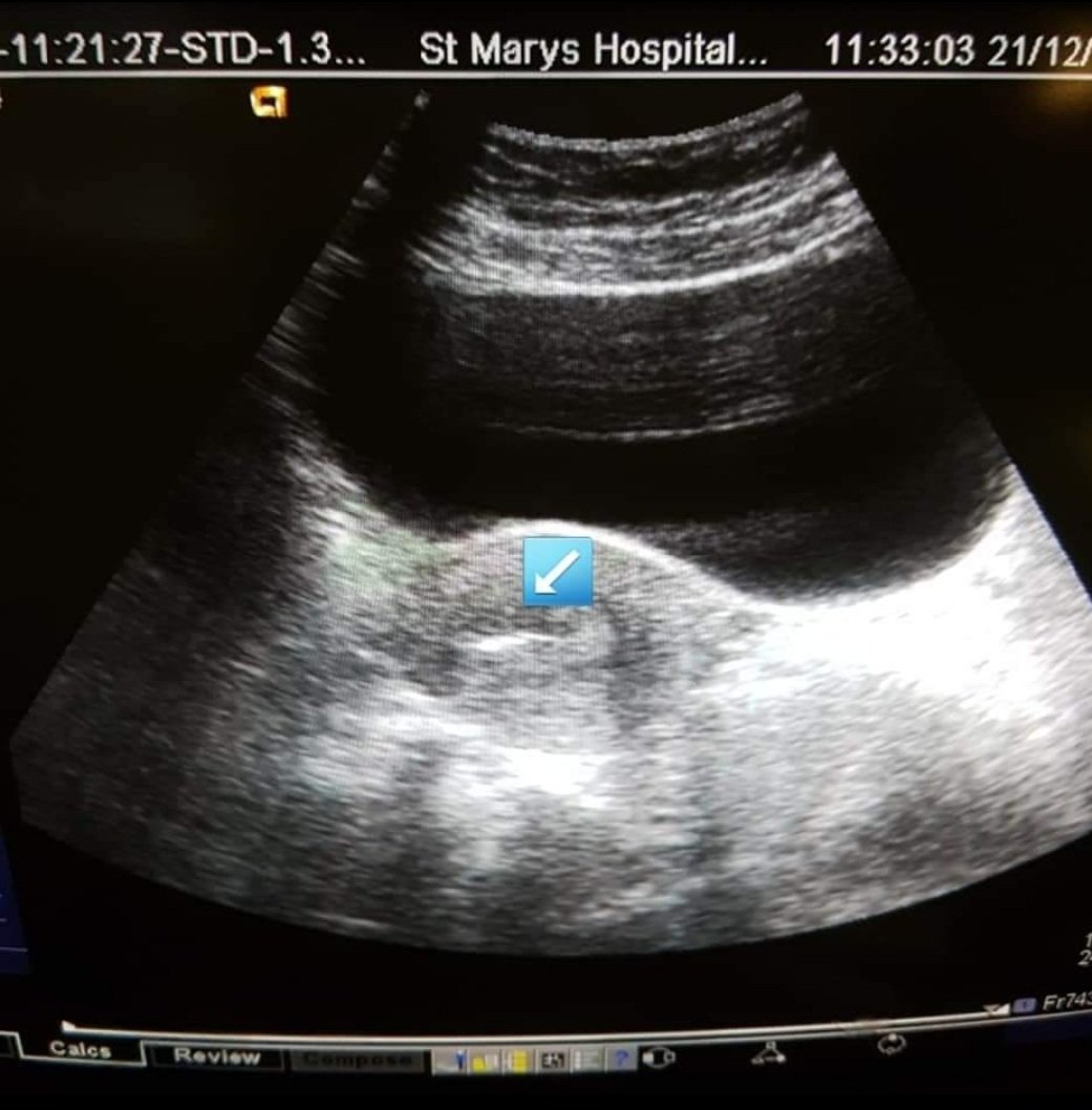 mtc_79's tweet photo. They say miracles never happen, well 3 years ago today ours most certainly did. The smallest little embryo eventually turning into our most beautiful funny amazing little boy.
We'll never be able to thank @stmarysivf enough for the amazing work they do
#IVF https://t.co/UuEMlgLpBA