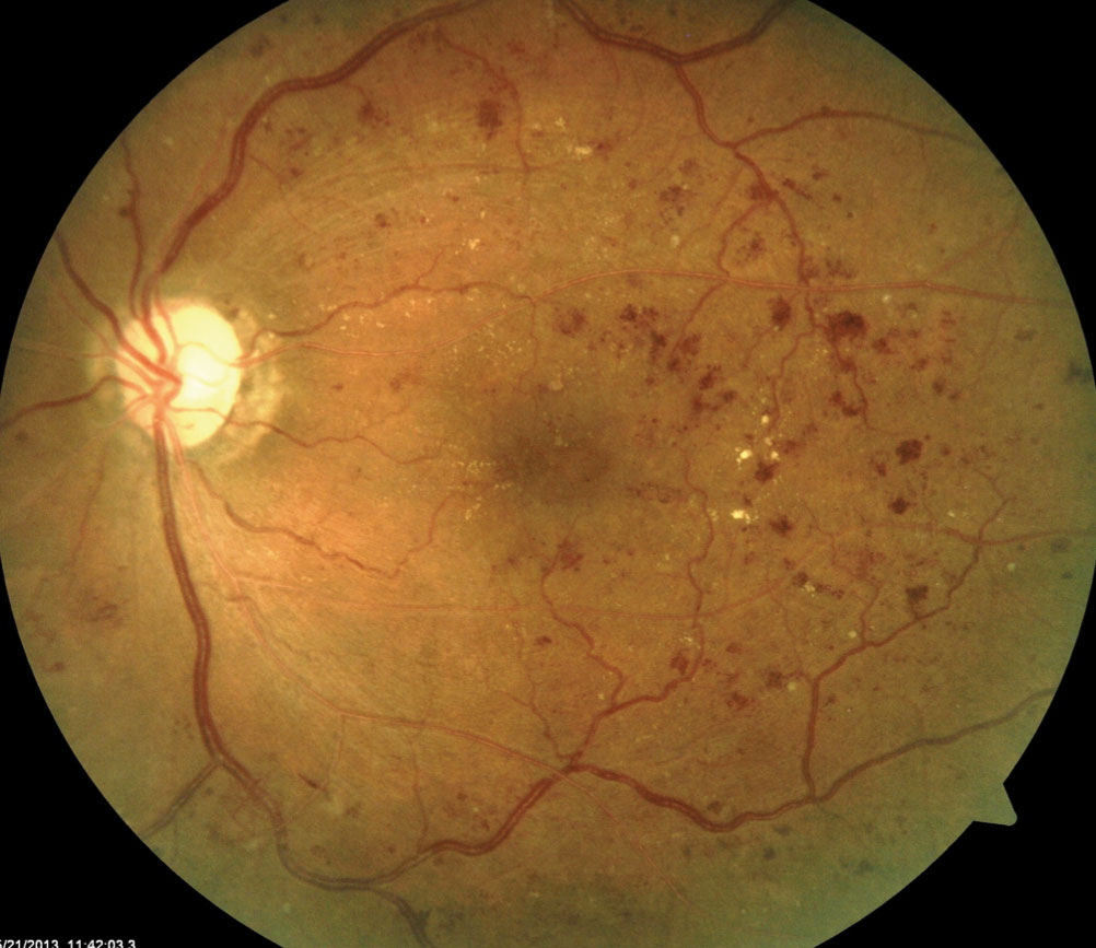 Ангиопатия сосудов сетчатки что это. Пролиферативная диабетическая ретинопатия. Постокклюзионная ретинопатия. Диабетическая ретинопатия сетчатки. Контузионная ретинопатия.