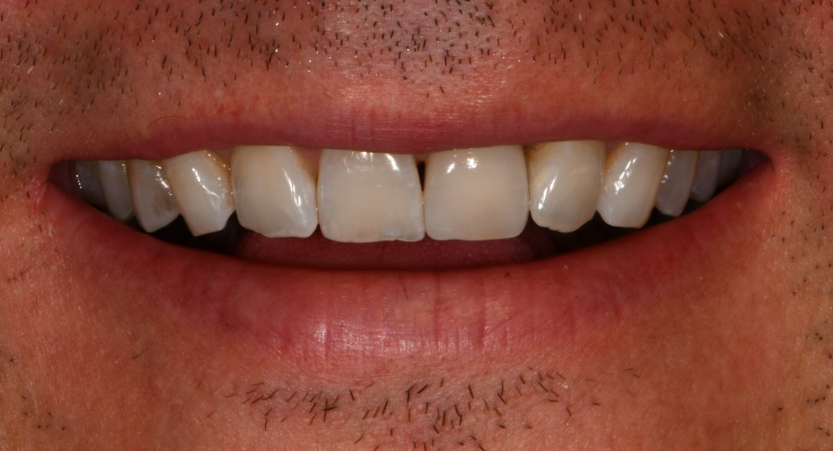 DCprosthodontic's tweet photo. All I want for the holidays are my two front teeth...Central incisor implant crown....Low smile...Happy Holidays!!!!! https://t.co/X6YujQ2xGq