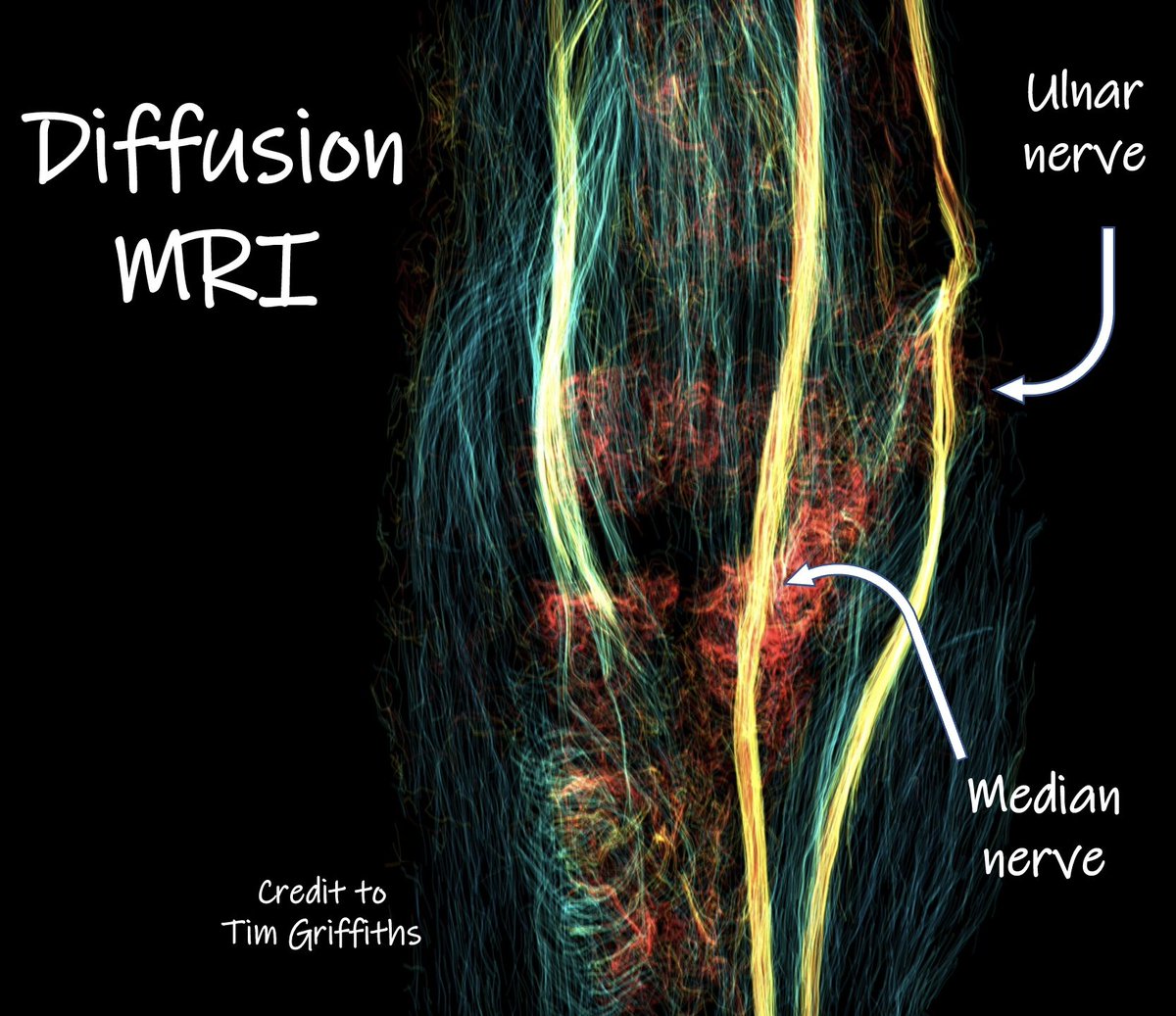Ryckie Wade (@ryckiewade) on Twitter photo Thank you so much <a href="/BAPRASvoice/">BAPRASvoice</a>! We are delighted to receive this grant to further our diffusion #MRI work in #CubitalTunnelSyndrome.
Thanks to <a href="/TTGrif/">Timothy Griffiths</a> for the awesome #DTI graphics 😍
<a href="/LeedsPlastics/">Leeds Department of Plastic Surgery</a> <a href="/LTHTResearch/">Leeds Research & Innovation</a> <a href="/LIMRLeeds/">LIMRLeeds</a> Thank you so much <a href="/BAPRASvoice/">BAPRASvoice</a>! We are delighted to receive this grant to further our diffusion #MRI work in #CubitalTunnelSyndrome.
Thanks to <a href="/TTGrif/">Timothy Griffiths</a> for the awesome #DTI graphics 😍
<a href="/LeedsPlastics/">Leeds Department of Plastic Surgery</a> <a href="/LTHTResearch/">Leeds Research & Innovation</a> <a href="/LIMRLeeds/">LIMRLeeds</a>