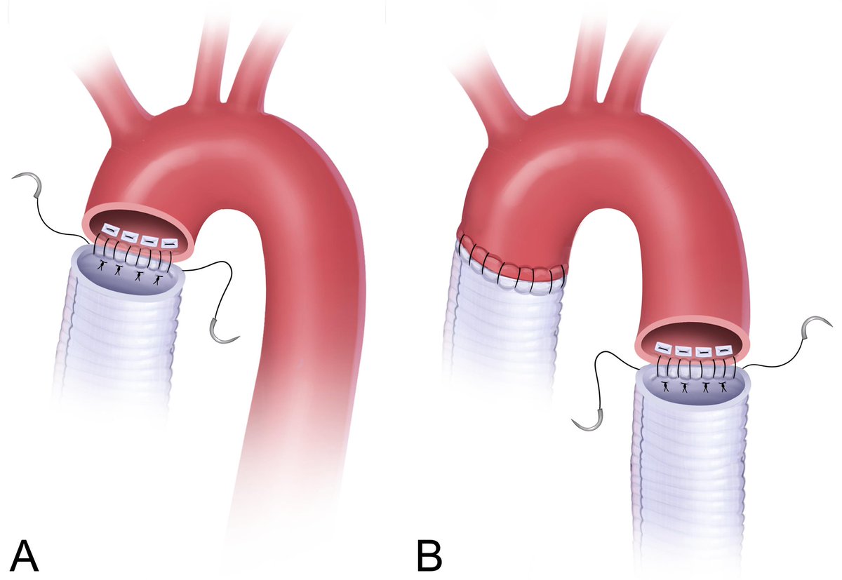 New: Cardiac &amp; Vascular Surgery! Practical Tips in Aortic Surgery (Elefteriades/Ziganshin). Practical advice on aortic surgery. For cardiac/aortic/vascular surgeons and trainees. Illustration based. Video clips. link.springer.com/book/10.1007/9…