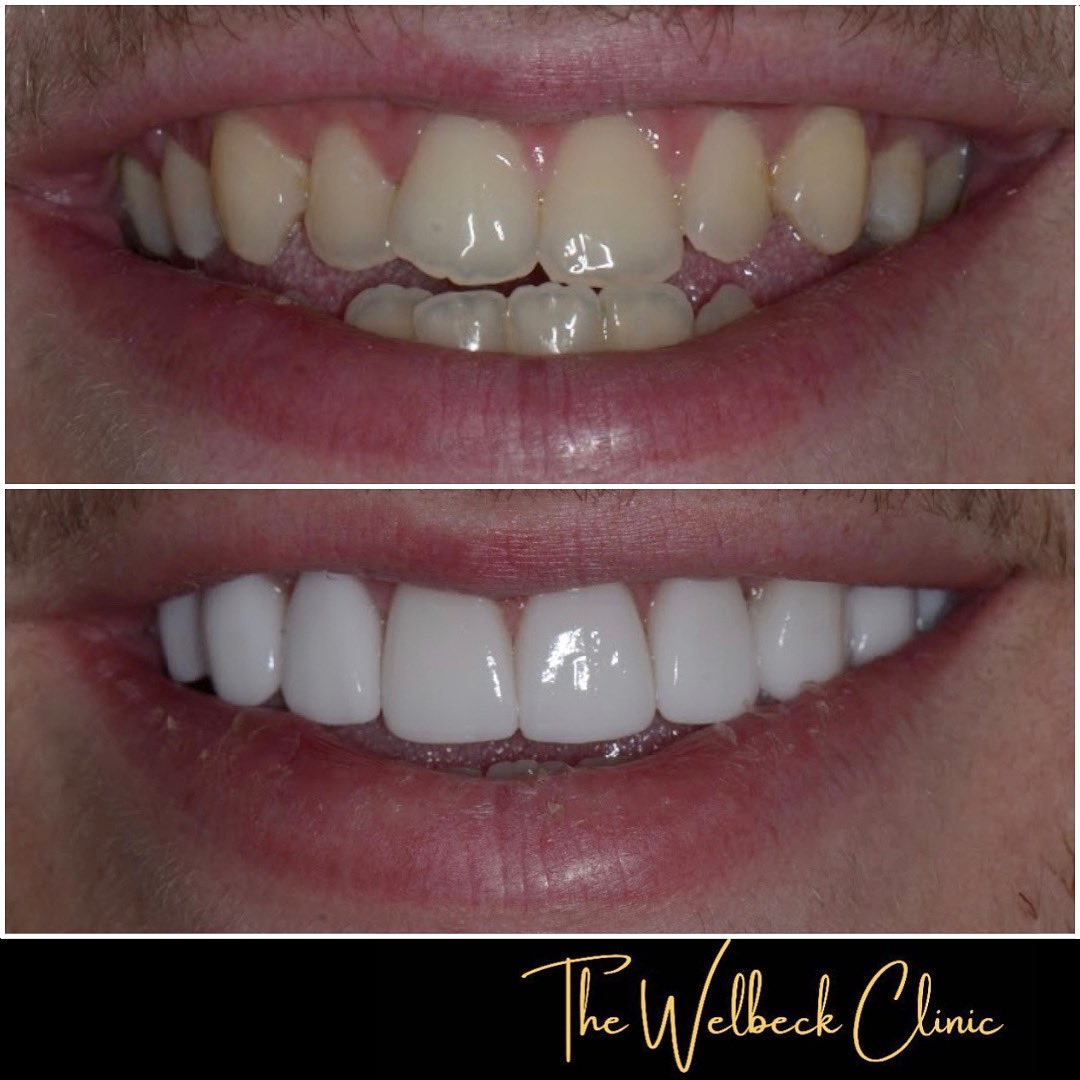 Get a bright new smile for the new year! 🔆
8 minimal preparation veneers done by Dr Ilaty at the <a href="/welbeckclinic/">The Welbeck Clinic</a> 

#porcelainveneers  #cosmeticdentist #designer #designersmile  
#veneers #veneersLondon #porcelaincrowns
#smilemakeover #naturallookingveneers #smile
#Marylebone