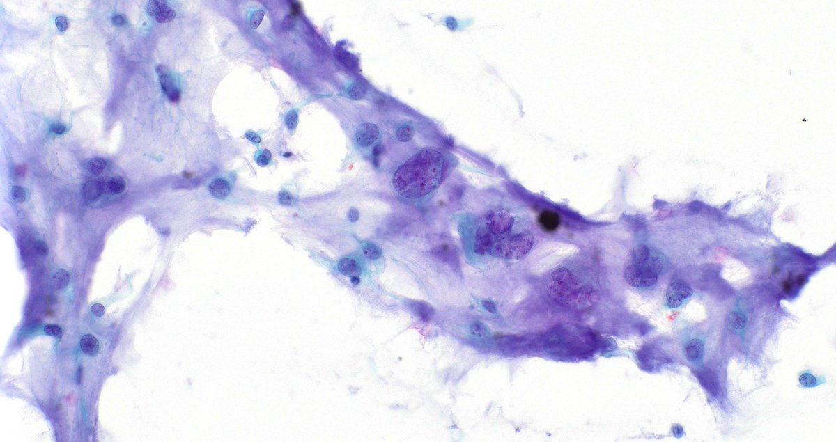 JaylouVelez's tweet photo. 59 year old female with parotid mass FNA. Diagnosis? @darcykerrMD @pepeheffernan @manuel_lg #cytopath #salivarygland https://t.co/1wcA0DWY9S