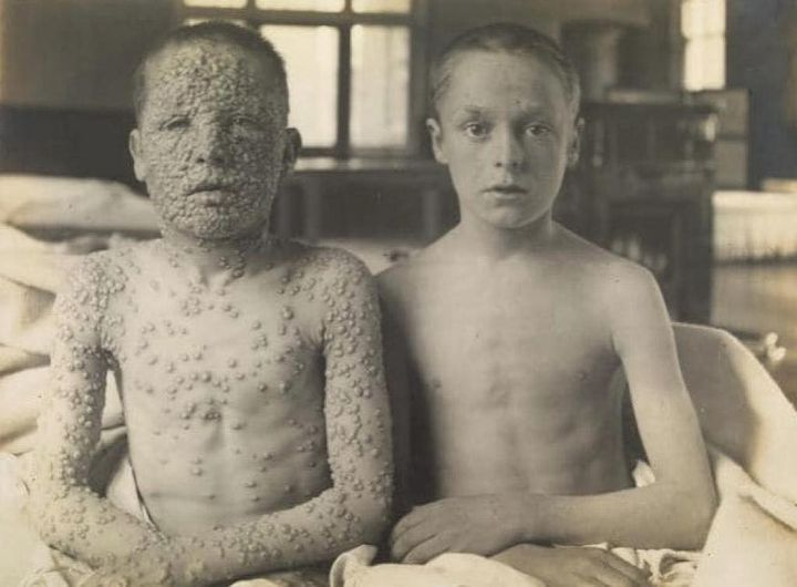 joewo01's tweet photo. The left not vaccinated.
The right had a vaccination.
Same thing with every preventable disease.
#covidvariant #COVID https://t.co/OgexINRgbp
