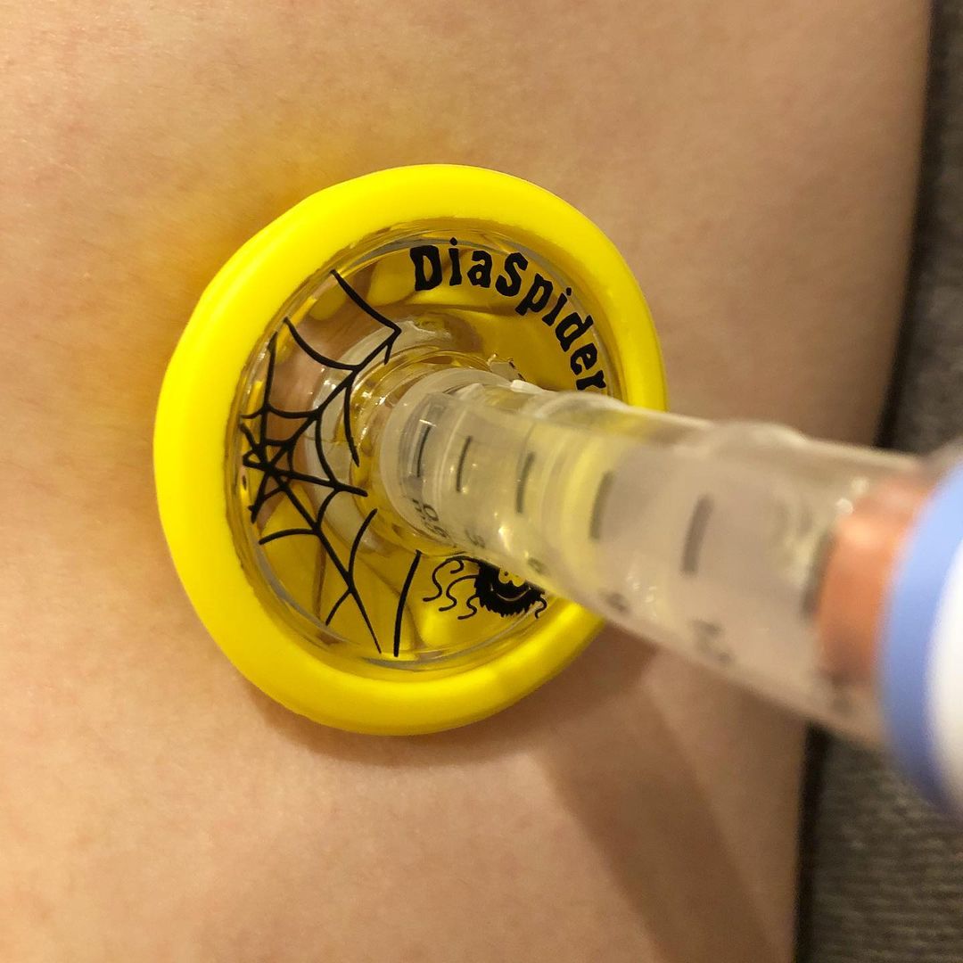 DiaSpider's tweet photo. How does DiaSpider work
1. Distracts atention
2. Prevents bruises on the body
3. Provides a safe puncture

More information about the product on our website: https://t.co/Ti3HHP0QI5 https://t.co/LXK2zRY7Ih