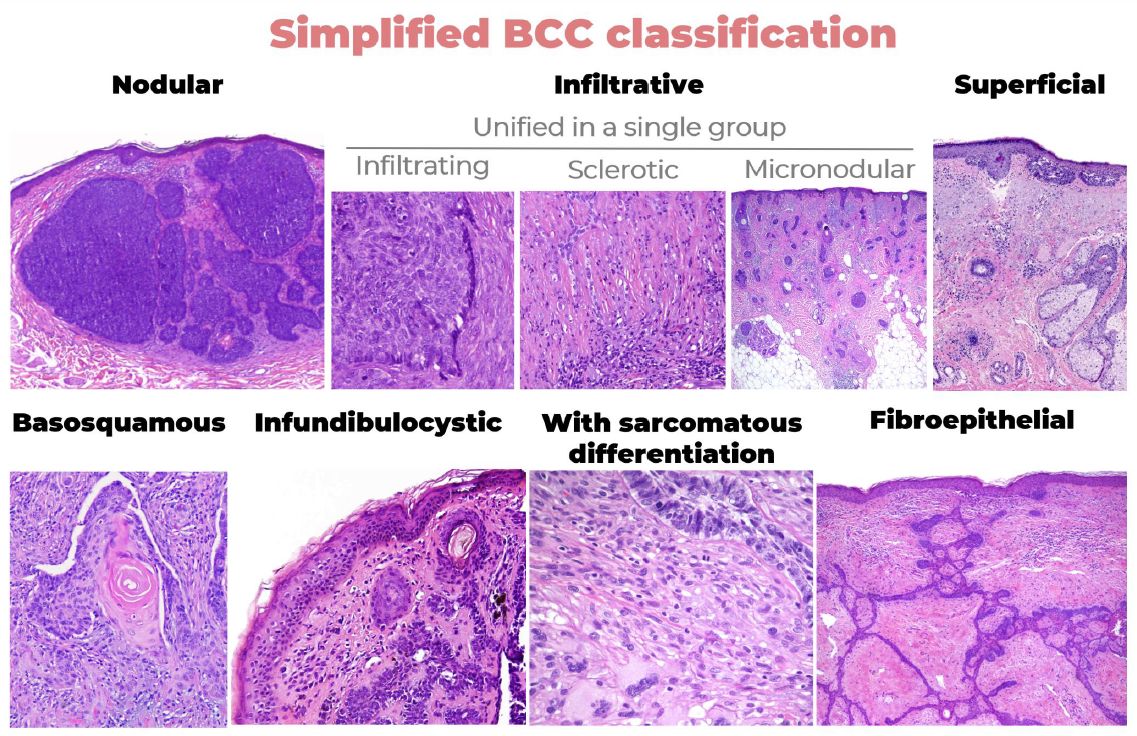 Our position paper on a simplified histopathological classification of basal cell carcinoma (European Consensus Project) is on line! With helpful indications for dermatopathologists, clinicians and researchers. @GEDP_es @IntSocDermpath @SEAP_IAP onlinelibrary.wiley.com/share/author/C…