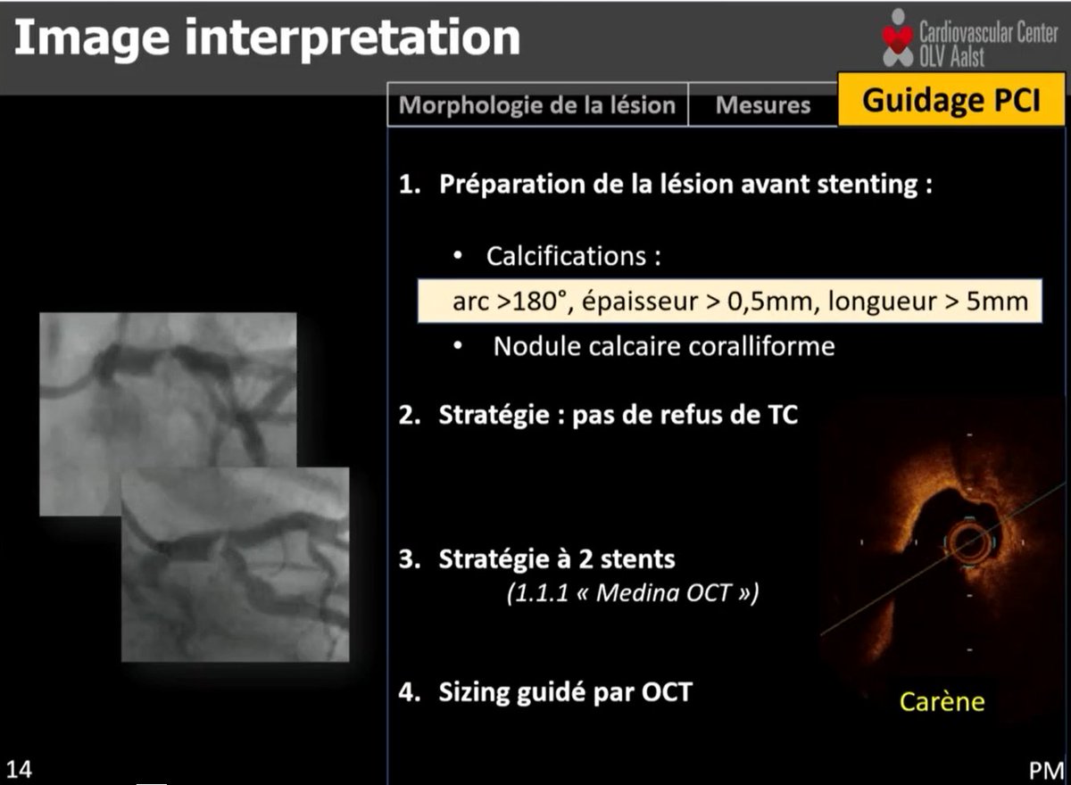 GRCI (@grcicardio) on Twitter photo Un moment incontournable de ce #GRCI 2021 : la session #EuroPCR. Elle est à voir ou revoir grâce au replay en accès gratuit !
💜Prise en charge d’un patient coronarien avec lésions calcifiées
👉 bit.ly/3dZ9wQy
@HakimBenamer <a href="/JacquesMonsegu/">MONSEGU Jacques</a> <a href="/HontonB/">Honton Benjamin</a> <a href="/pmtfff/">Motreff Pascal</a> Un moment incontournable de ce #GRCI 2021 : la session #EuroPCR. Elle est à voir ou revoir grâce au replay en accès gratuit !
💜Prise en charge d’un patient coronarien avec lésions calcifiées
👉 bit.ly/3dZ9wQy
@HakimBenamer <a href="/JacquesMonsegu/">MONSEGU Jacques</a> <a href="/HontonB/">Honton Benjamin</a> <a href="/pmtfff/">Motreff Pascal</a>