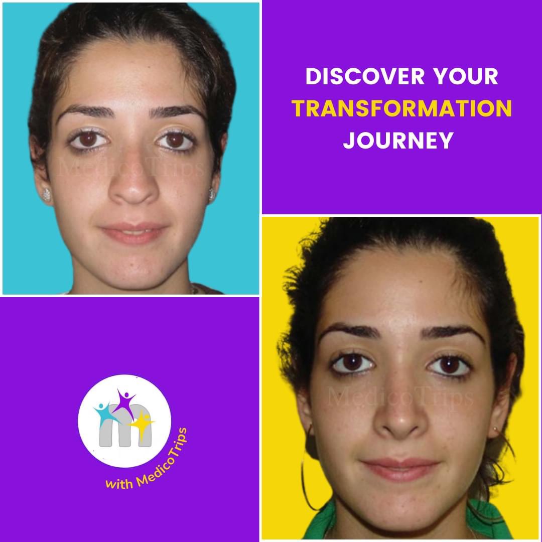 medicotrips's tweet photo. At MedicoTrips, we recommend nose job surgery in Turkey as a more cost-effective option for our customers! π
Discover your transformation journey with MedicoTrips: https://t.co/RdspFFpPAz
#rhinoplasty #nosejob #nosereshape #aestheticsurgery #nosecorrection https://t.co/ywn9Pbs4vY