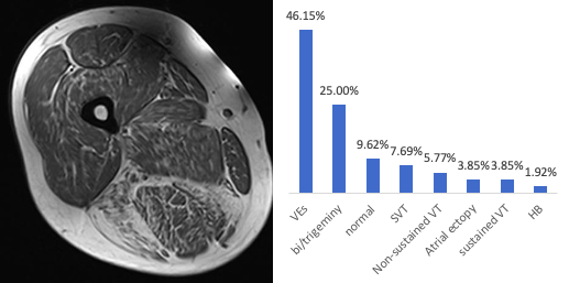 Brain1878's tweet photo. Vivekanandam et al. reveal significant cardiac and neuromuscular morbidity in patients with Andersen-Tawil syndrome, a channelopathy characterised by episodic weakness, cardiac arrhythmia and dysmorphic features. https://t.co/Pht9MFDrQm https://t.co/EBwS2B5Uo9
