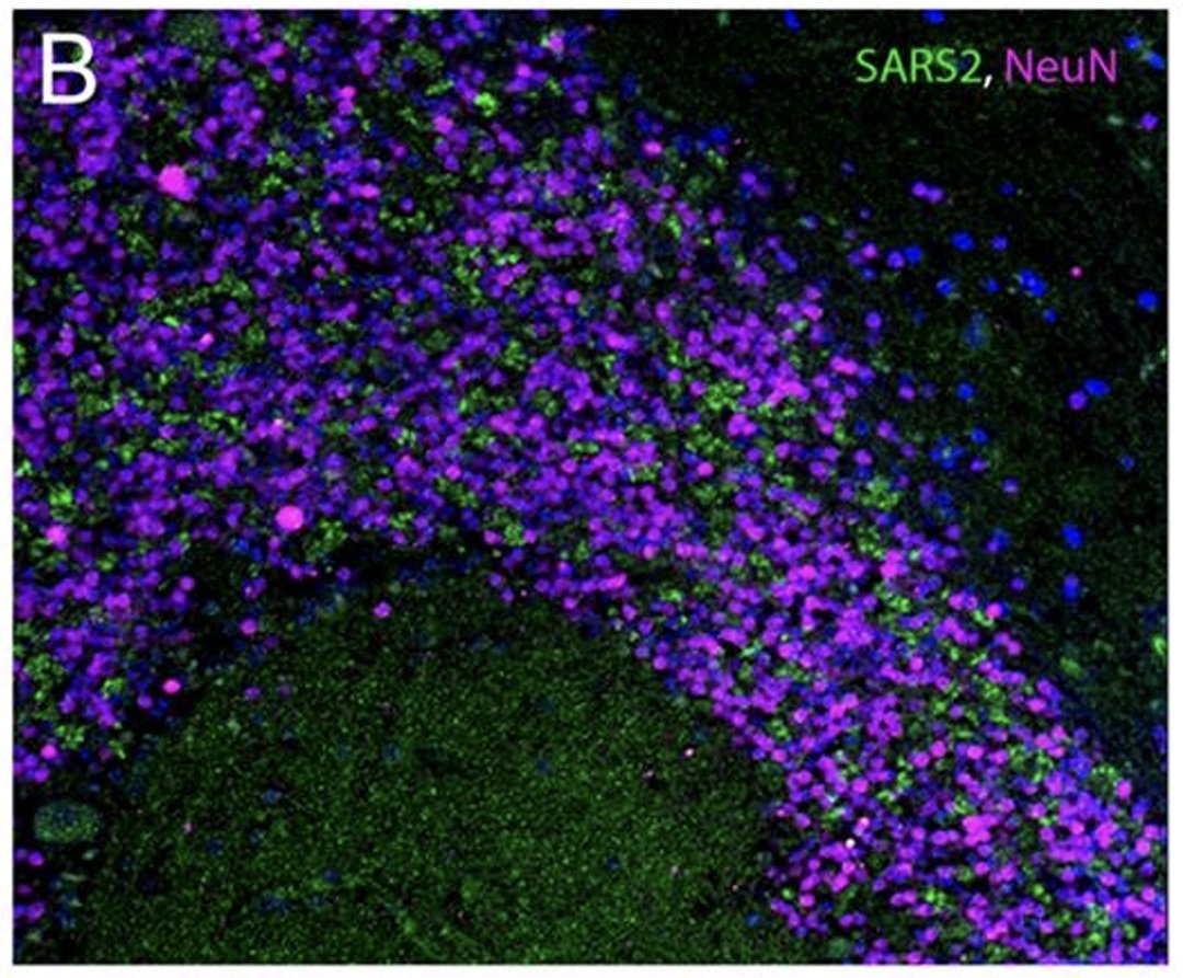 Martin_Moder's tweet photo. Autopsie Pre-Print: SARS-CoV-2 noch viele Monate nach der Infektion im Gehirn nachweisbar. Hier Ausschnitt des Kleinhirns. Lila: Neurone. Grün: SARS-CoV-2 Nucleocapsid. Spielt vermutlich in die LongCovid Thematik. Mehr als eine Atemwegserkrankung ☝🏻 https://t.co/t4TIpBcTEn https://t.co/WXjbAZo7cr