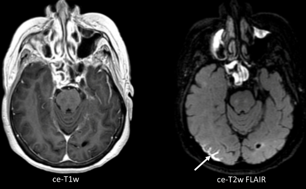 BJR_Radiology's tweet photo. Review
Brain metastases: the role of clinical imaging
https://t.co/fLuucxTPL4
#OpenAccess #Radiology #NeuroRad @MarionSmits https://t.co/DYLD47ICyo