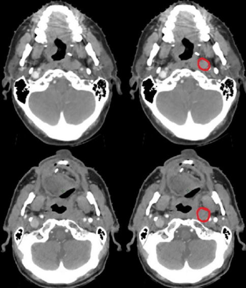 BIR Journals (@bjr_radiology) on Twitter photo The quantitative impact of joint peer review with a specialist radiologist in head and neck cancer radiotherapy planning
bit.ly/3Eky7d2
#Radiology #RadOnc #Radiotherapy <a href="/DrKevinChiu/">Kevin Chiu</a> The quantitative impact of joint peer review with a specialist radiologist in head and neck cancer radiotherapy planning
bit.ly/3Eky7d2
#Radiology #RadOnc #Radiotherapy <a href="/DrKevinChiu/">Kevin Chiu</a>