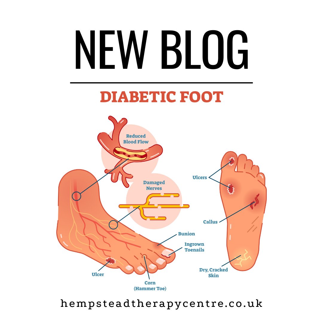 Diabetes is a lifelong condition that can cause foot problems. Some of these problems occur because the nerves &amp; blood vessels supplying the feet are damaged.  Find out more in our latest blog article:  zcu.io/fAIq #Chiropody #Podiatry #Medway