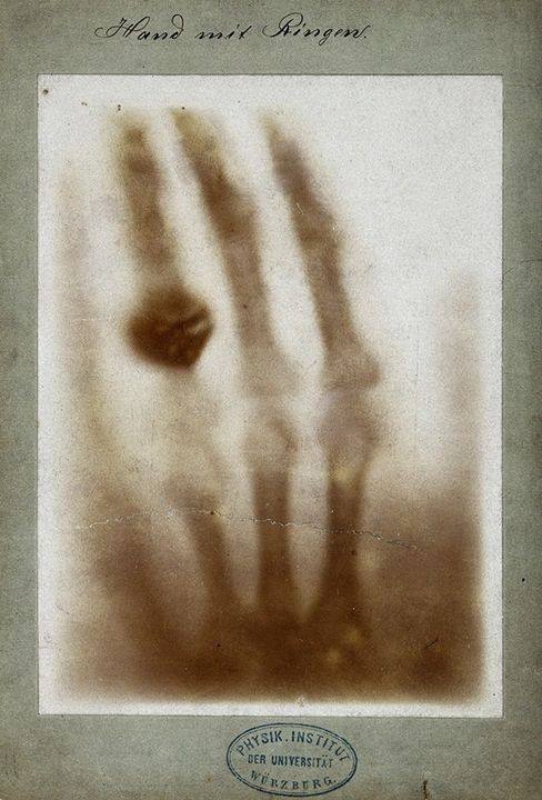 This is one of the most famous images in photographic history. 

The first ever X-ray image was taken on #OTD in 1895 by Wilhelm Röntgen – who was then awarded the first #NobelPrize in Physics in 1901. 

Read the story, 'A Helping Hand from the Media':  bit.ly/2S3TlUS