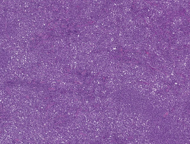 SibaElHussein's tweet photo. Signet ring cell morphology, seen not only in carcinoma, follicular lymphoma can show this feature as well, case by @ljmedeirosMD | revisit slides https://t.co/XU3tafzH5I  (case 4) | notes https://t.co/1TSK6RWaRF #hemepath #pathtwitter #lymsm @KirillLyapichev @Xiaoqiong_Wang https://t.co/qd0QQtBZJh