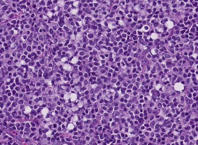 SibaElHussein's tweet photo. Signet ring cell morphology, seen not only in carcinoma, follicular lymphoma can show this feature as well, case by @ljmedeirosMD | revisit slides https://t.co/XU3tafzH5I  (case 4) | notes https://t.co/1TSK6RWaRF #hemepath #pathtwitter #lymsm @KirillLyapichev @Xiaoqiong_Wang https://t.co/qd0QQtBZJh