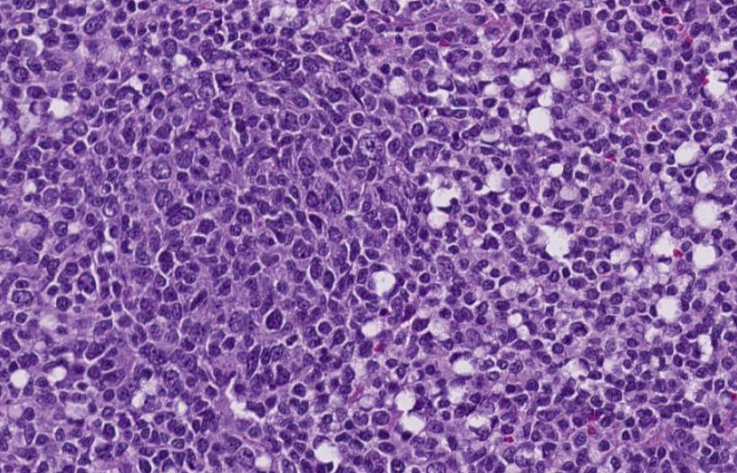 SibaElHussein's tweet photo. Signet ring cell morphology, seen not only in carcinoma, follicular lymphoma can show this feature as well, case by @ljmedeirosMD | revisit slides https://t.co/XU3tafzH5I  (case 4) | notes https://t.co/1TSK6RWaRF #hemepath #pathtwitter #lymsm @KirillLyapichev @Xiaoqiong_Wang https://t.co/qd0QQtBZJh