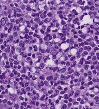 SibaElHussein's tweet photo. Signet ring cell morphology, seen not only in carcinoma, follicular lymphoma can show this feature as well, case by @ljmedeirosMD | revisit slides https://t.co/XU3tafzH5I  (case 4) | notes https://t.co/1TSK6RWaRF #hemepath #pathtwitter #lymsm @KirillLyapichev @Xiaoqiong_Wang https://t.co/qd0QQtBZJh