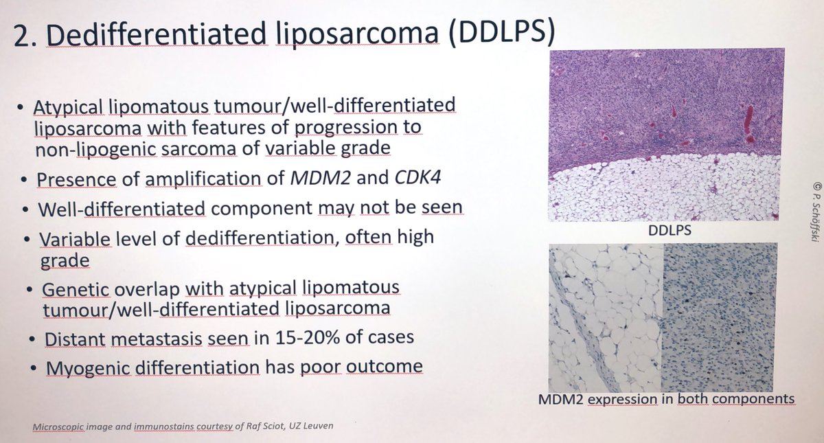schoffski's tweet photo. I now have two MDM2 inhibitors available in ongoing clinical trials in Leuven for patients with advanced dedifferentiated liposarcoma and select other mesenchymal and epithelial tumours with MDM2 amplification. Get in touch in case you have potential candidates! https://t.co/Dp8Xtc9akH