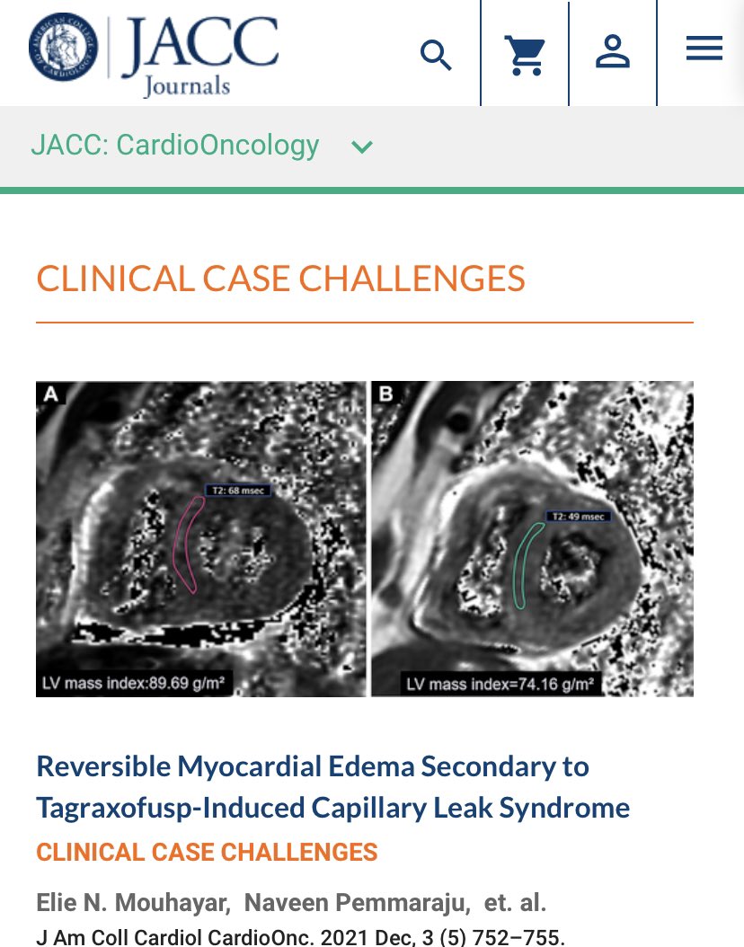 👉👉👉Delighted to share our #CardioOnc collaborative multi-disciplinary work led by <a href="/EMouhayar/">Elie Mouhayar</a> &amp; <a href="/DanielleHammo20/">Danielle Hammond, MD</a>  @jaccjournals jacc.org/doi/10.1016/j.… | An important clinical topic: Successful 👏🏽 Reversible myocardial edema in patient with #Tagraxofusp-induced #CLS | #BPDCN