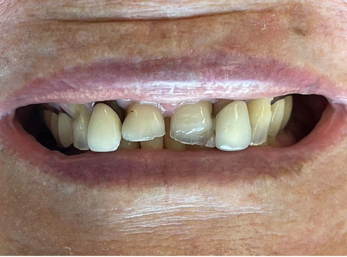 HallmarkLab's tweet image. What a difference!  Dentistry by Dr. Corey Felix, implants by Straumann, customization by Heather Sullivan at Hallmark Dental.   #meagan_straumannlife #straumannglobal #coreyfelix #newsmile