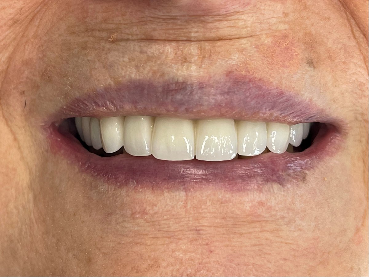 HallmarkLab's tweet image. What a difference!  Dentistry by Dr. Corey Felix, implants by Straumann, customization by Heather Sullivan at Hallmark Dental.   #meagan_straumannlife #straumannglobal #coreyfelix #newsmile