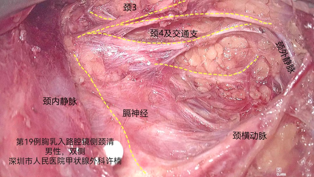 Side neck dissection by endoscopic