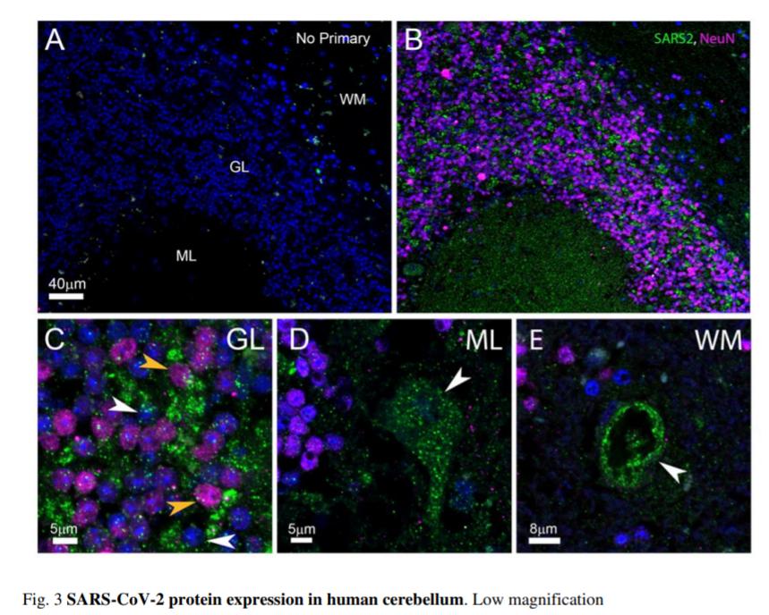 LongCovidSOS's tweet photo. "Persistence of low-level SARS-CoV-2 RNA was frequently detected across multiple tissue categories among all late cases, despite being undetectable in plasma. Notably, RNA was detected in the brains of all 6 late cases and across most locations evaluated in the brain in 5" https://t.co/hPj1vgoq21