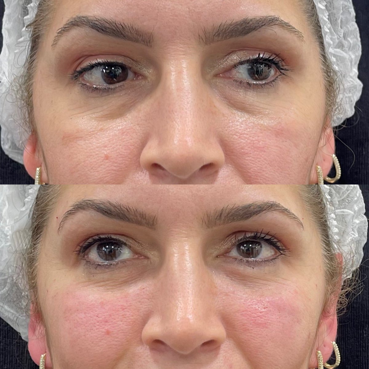 SehriyarDr's tweet photo. Malar (nasojugal) grooves are oblique lines on the cheeks which give the face “unhappy and aged” image. These dedects can be treated successfully by “deep injection” of dermal fillers, especially by semi-permanent ones. https://t.co/wtnF9udSk8