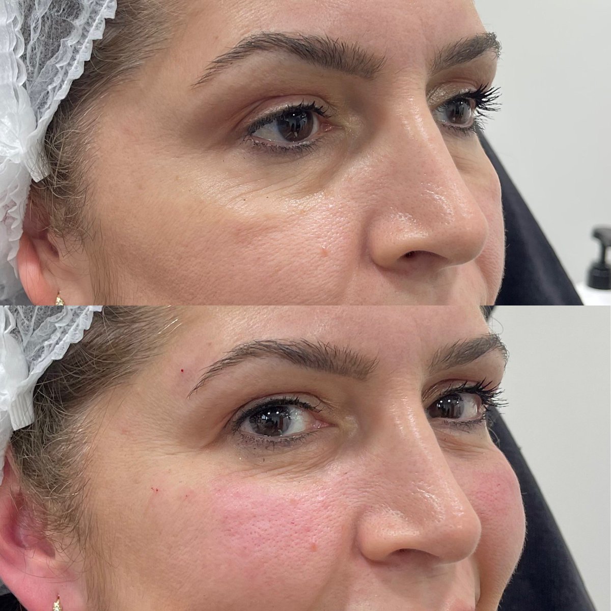 SehriyarDr's tweet photo. Malar (nasojugal) grooves are oblique lines on the cheeks which give the face “unhappy and aged” image. These dedects can be treated successfully by “deep injection” of dermal fillers, especially by semi-permanent ones. https://t.co/wtnF9udSk8