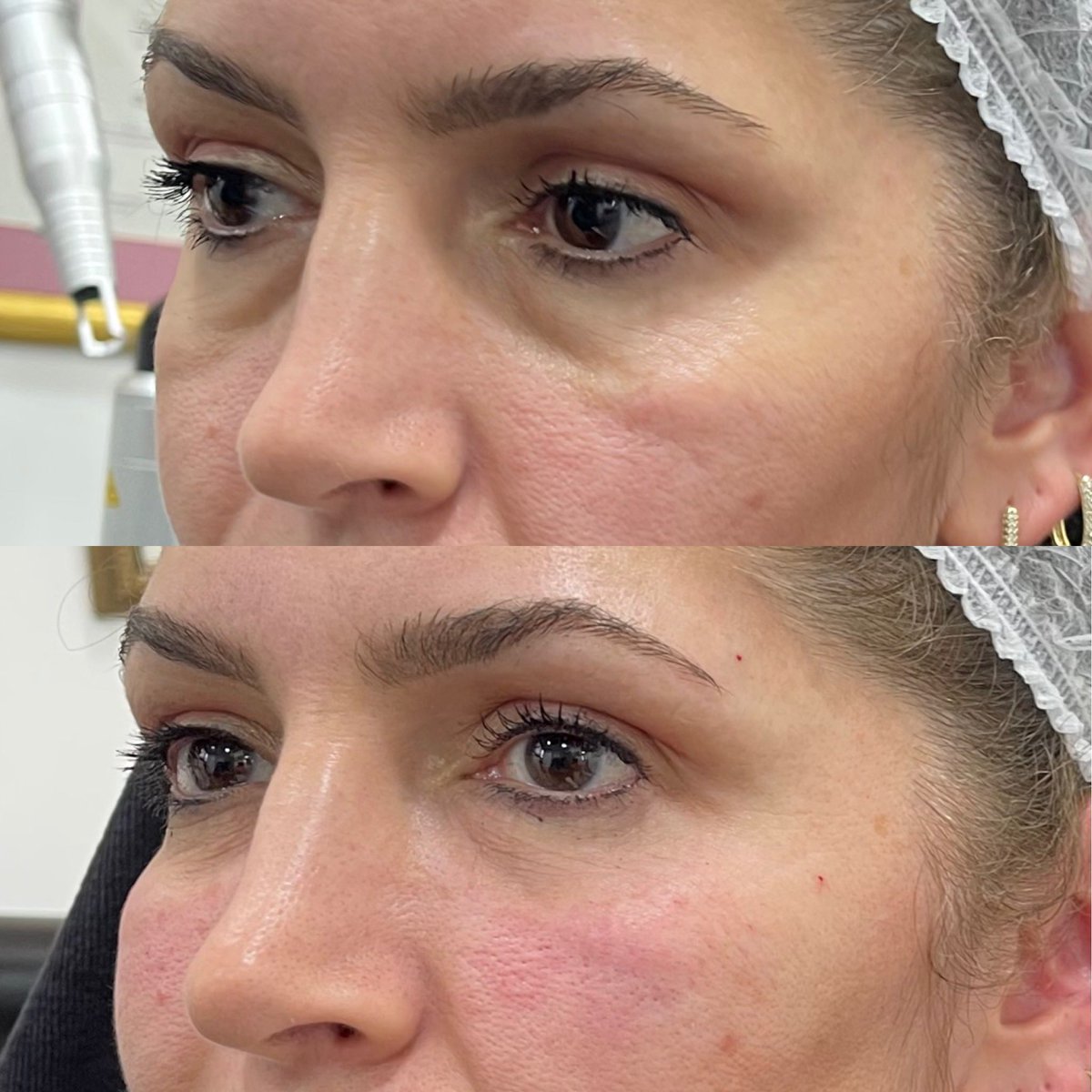 SehriyarDr's tweet photo. Malar (nasojugal) grooves are oblique lines on the cheeks which give the face “unhappy and aged” image. These dedects can be treated successfully by “deep injection” of dermal fillers, especially by semi-permanent ones. https://t.co/wtnF9udSk8