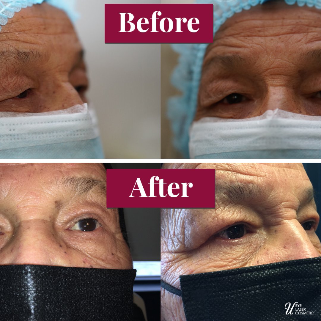 uelc_ca's tweet photo. How much of a difference can an eyelid lift make in your appearance? Check out these before and after photos!. https://t.co/D8uWRhhNTo #UELC #blepharoplasty #blepharoplastytoronto #belph https://t.co/MBoNNd7zq3