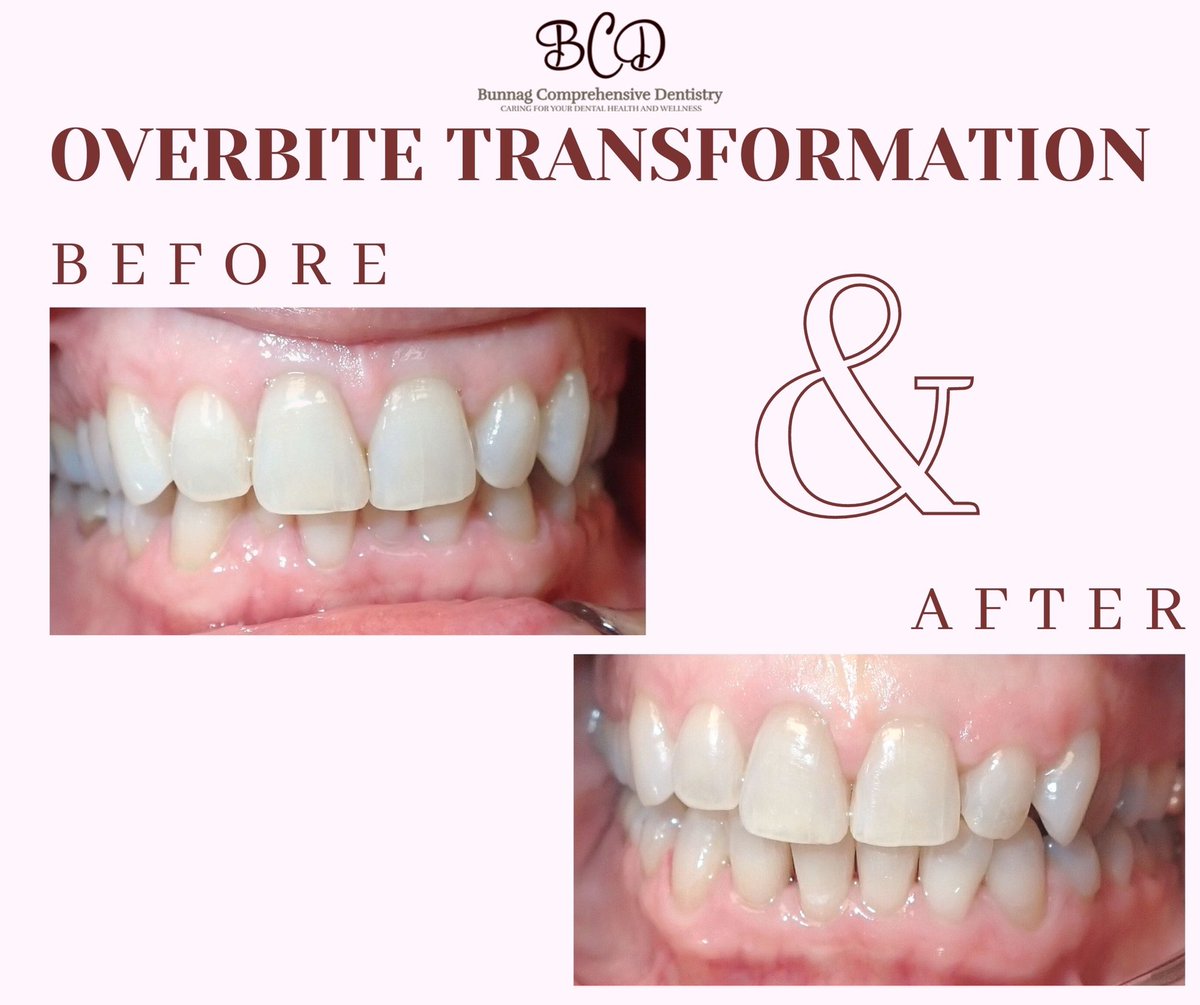 DrBunnag's tweet photo. Wow, look at that overbite transformation! Our patient is very happy with their new smile thanks to FASTBRACES®! FASTBRACES® is a technology we have implemented in our practice, that allows us to provide comprehensive orthodontics care in-house. #fastbraces #smiletransformation https://t.co/3tOnaDc54b