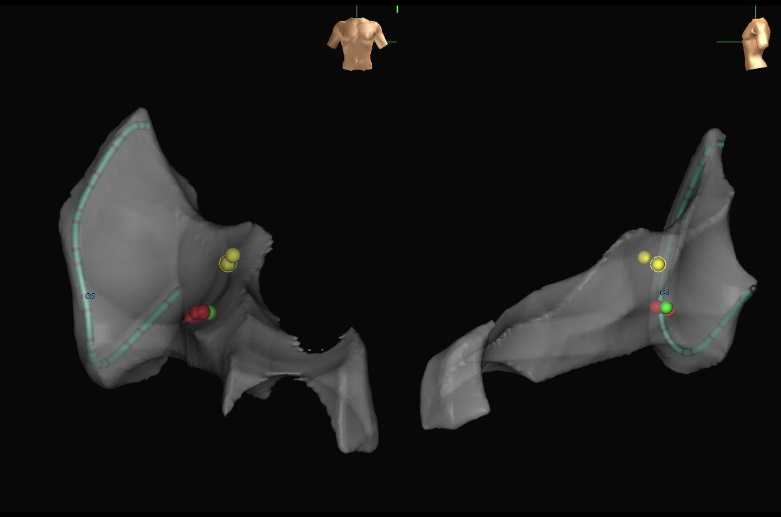 Ablation of posteroseptal AP in a 22/M with recurrent palpitations. ⚡️ in 2.7 seconds! Thank you for the gift of learning <a href="/melchami99/">Mikhael El-Chami</a> #Epeeps #Emoryheart
