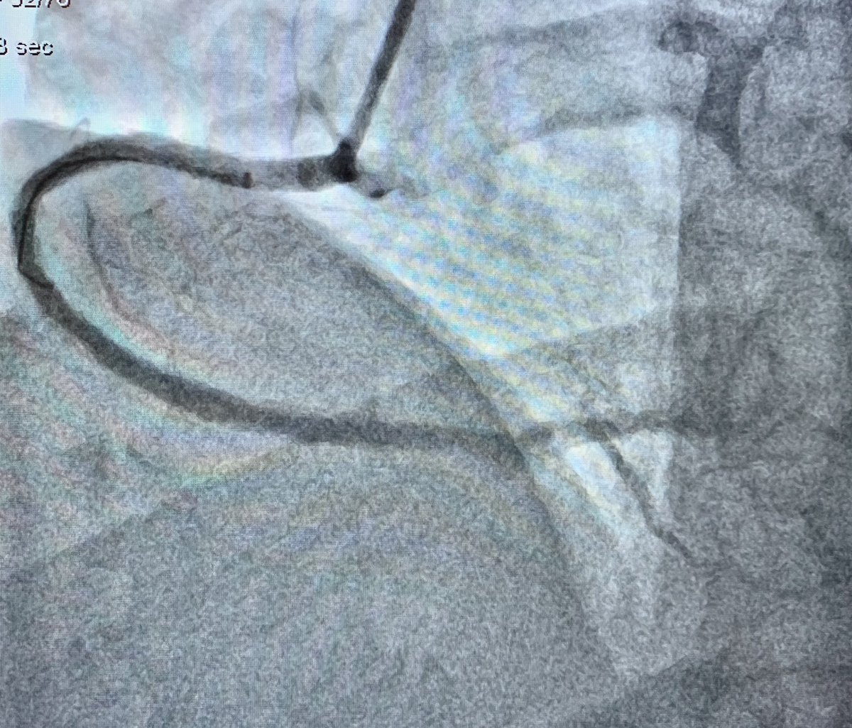 ReVascMed (@revascmed) on Twitter photo Last elective coronary CTO PCI before Christmas with <a href="/jcgeorgemd/">Jon George</a> at #PennsyInterventions using #BiRadial access, #CrossBoss, #AWE Reentry, and #IVUS imaging. <a href="/GPAngioClub/">Phila Angio Club</a> <a href="/ACVCPhila/">Academy for CardioVascular Collaboration</a> <a href="/PennCVFellows/">Penn Cardiology Fellows</a> <a href="/BSCCardiology/">BostonSci Cardiology</a> <a href="/ASAHIINTECCMEDI/">ASAHI INTECC CO.,LTD - Medical Division</a> Last elective coronary CTO PCI before Christmas with <a href="/jcgeorgemd/">Jon George</a> at #PennsyInterventions using #BiRadial access, #CrossBoss, #AWE Reentry, and #IVUS imaging. <a href="/GPAngioClub/">Phila Angio Club</a> <a href="/ACVCPhila/">Academy for CardioVascular Collaboration</a> <a href="/PennCVFellows/">Penn Cardiology Fellows</a> <a href="/BSCCardiology/">BostonSci Cardiology</a> <a href="/ASAHIINTECCMEDI/">ASAHI INTECC CO.,LTD - Medical Division</a>