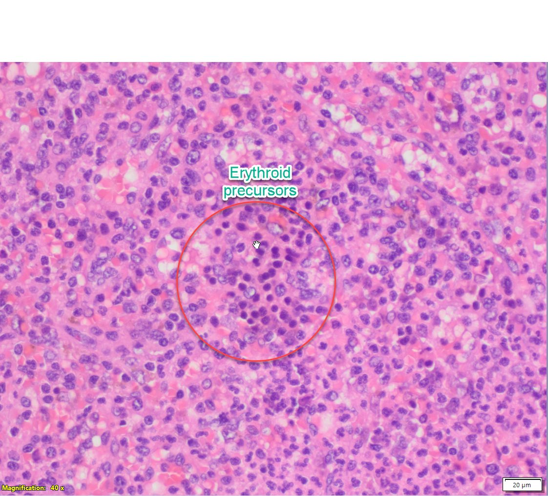 sanamloghavi's tweet image. We rarely see #splenectomy specimens anymore but when we do.. it’s glorious. This #spleen from a pt with autoimmune hemolytic anemia read the textbooks!shows extramedullary hematopoiesis, increased neutrophils, red pulp congestion and hemophagocytosis. #hemepath at its best!!!