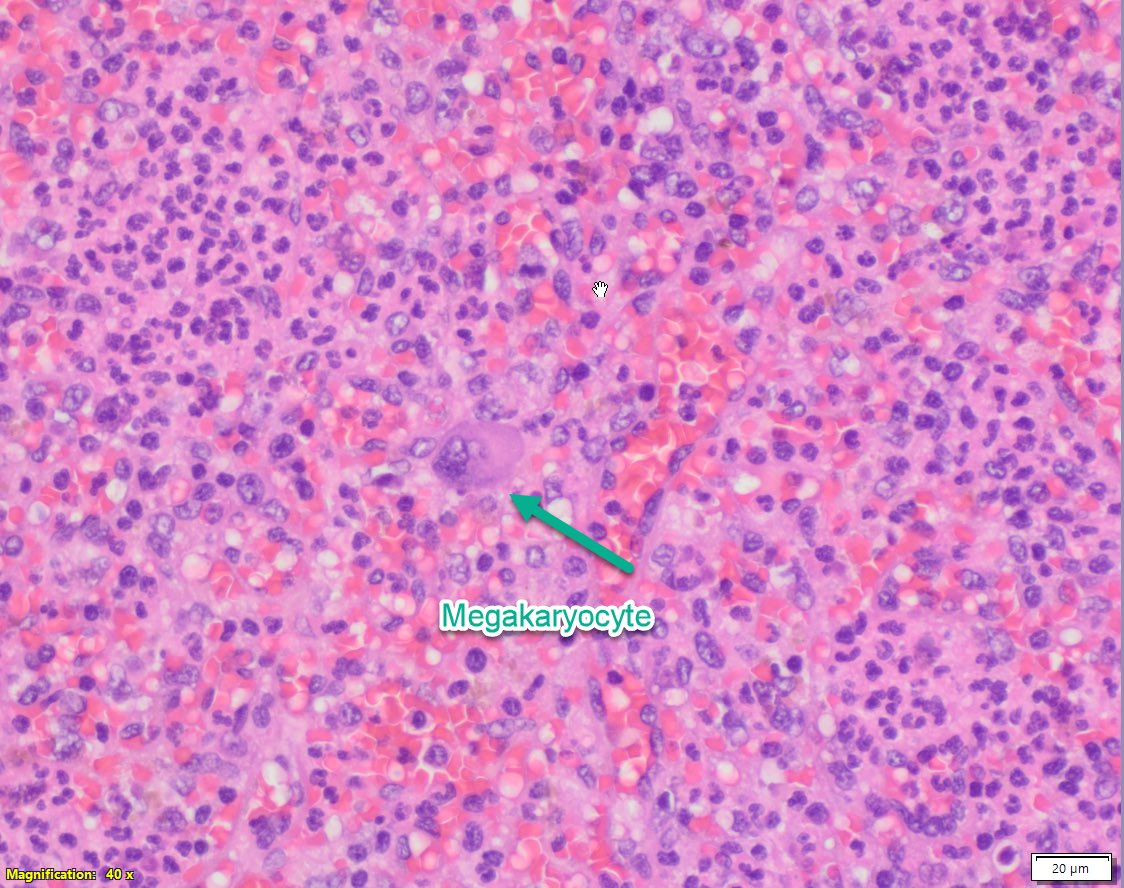 sanamloghavi's tweet image. We rarely see #splenectomy specimens anymore but when we do.. it’s glorious. This #spleen from a pt with autoimmune hemolytic anemia read the textbooks!shows extramedullary hematopoiesis, increased neutrophils, red pulp congestion and hemophagocytosis. #hemepath at its best!!!