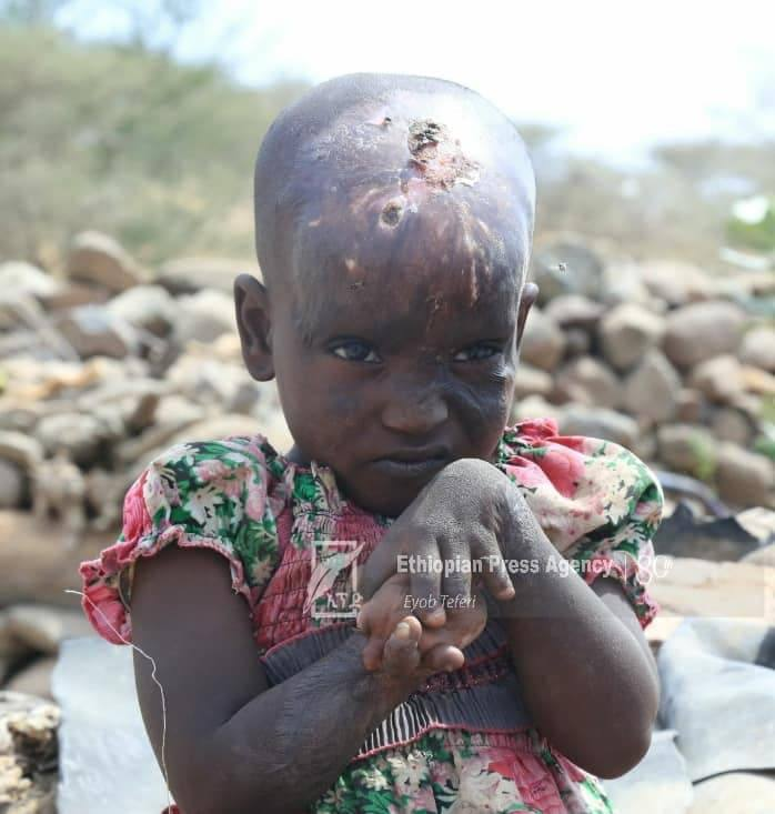 GuteBule's tweet photo. #KnowMore: On August 5, 2021, #TPLFTerroristGroup deliberately shelled #Galicoma town killing 240+ out of whom 100 were children.  A 4 year old baby girl, miraculously survived the attack although severely burned. #NoMore!  She deserves justice! https://t.co/PBE0GW8y0U