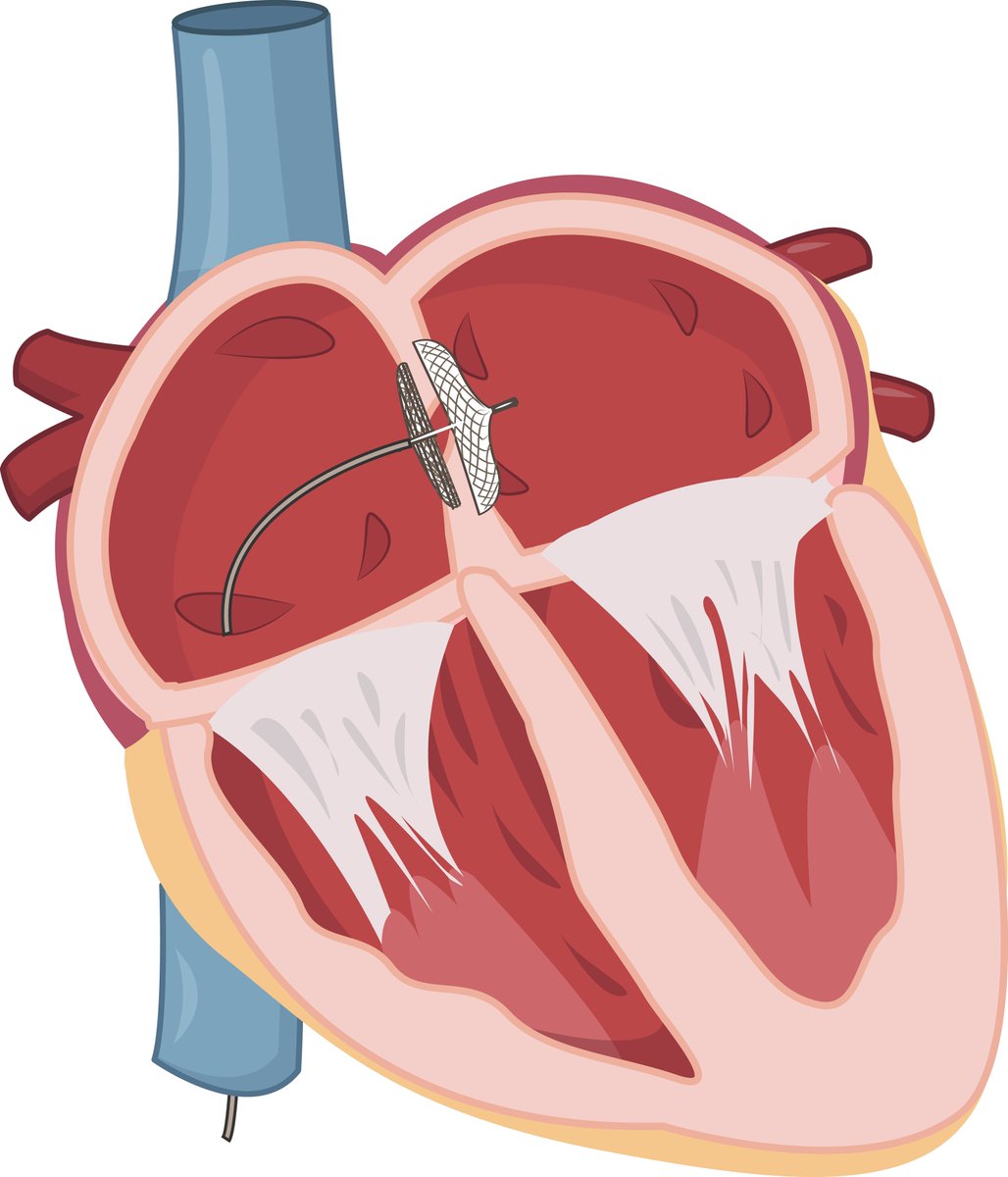 ChinMedJ's tweet photo. #Parylene coating of #occluders offers a safer alternative to traditional #nitinol #implants for #AtrialSeptalDefects and provides hope to patients with a #NickelAllergy.
Read more in @ChinMedJ: https://t.co/1rwCI7TI49 https://t.co/eQMbRnNskf
