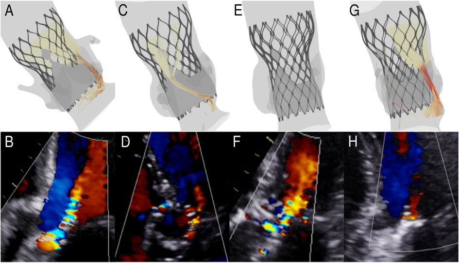 journalCCT's tweet photo. Can computational fluid dynamics using #yesCCT help predict which patients will have a ⬆️rate of death after TAVR? Check out this study by Dowling et al. which supports the use of CFD to predict paravalvular leak &amp; long-term adverse outcomes after TAVR.
https://t.co/8hwODmgKZ3 https://t.co/zWwgnEjJQ2