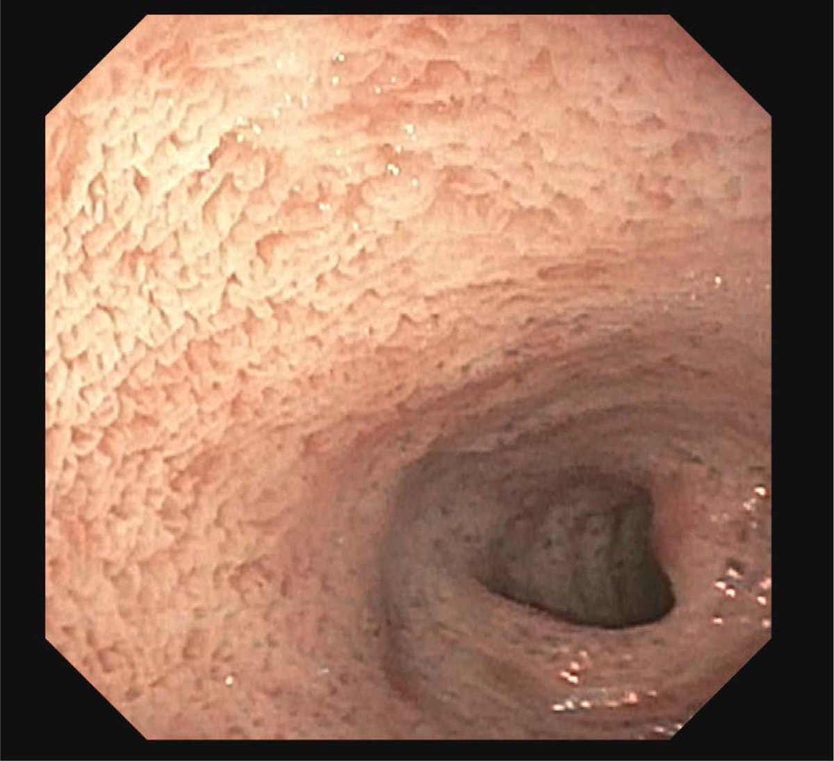 JPGNReports's tweet photo. #CaseReport highlighting that if a #patient presents with abnormal lipid profile with positive stool fat --> keep Chylomycron Retention Disease on the differential EVEN in the absence of #chronicdiarrhea or vomiting.
https://t.co/7VbT3xeUHy
#pediatricgi #pedigitwitter #gitwitter https://t.co/YMWmefD0CG