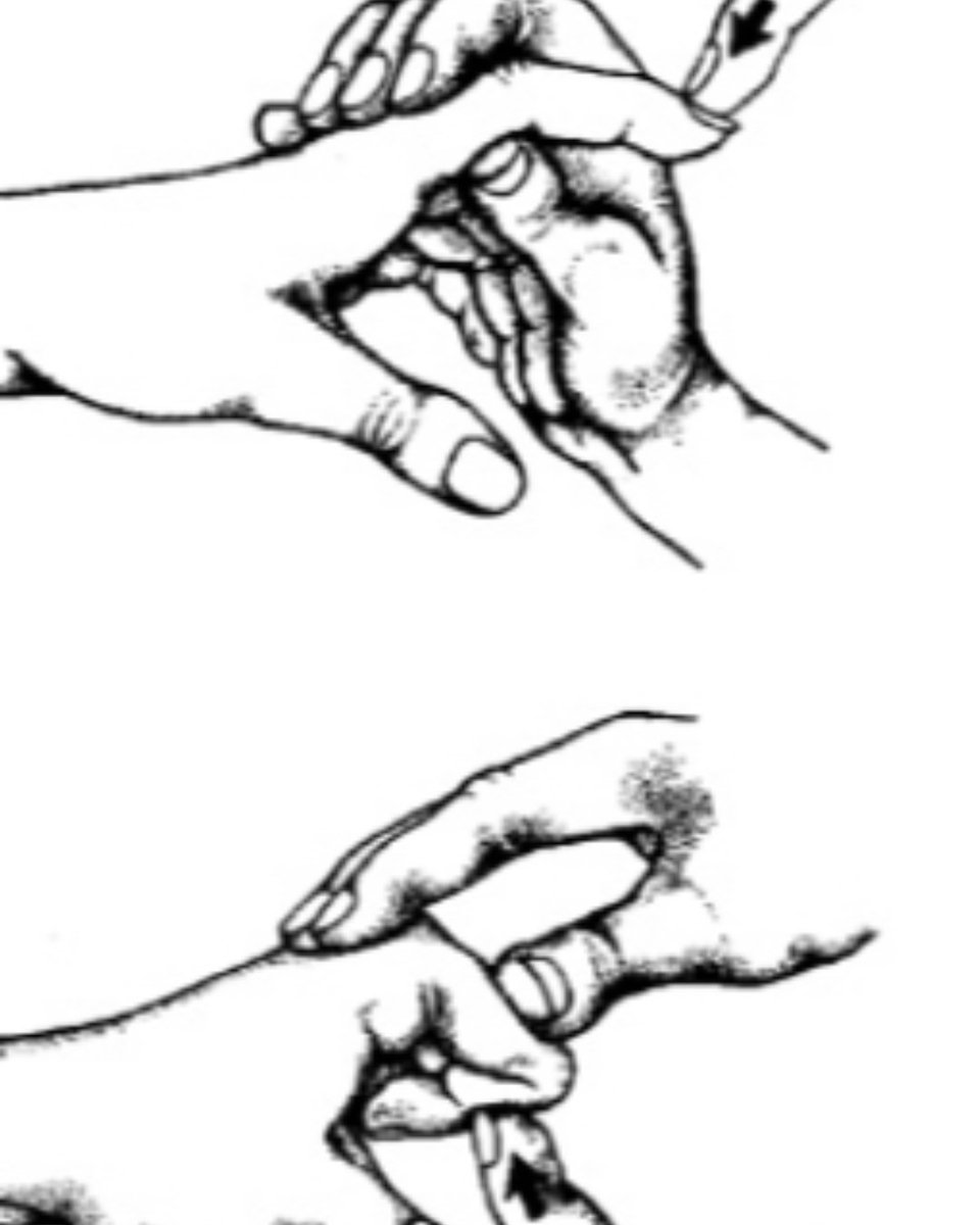 The Bunnel's Test

- Intrinsic tightness present if PIP can be flexed easily when MCP is flexed but NOT when MCP is extended
- Extrinsic tightness present if PIP can be flexed easily when MCP is extended but NOT when MCP is flexed
#handtherapy #hand <a href="/HandSociety/">ASSH</a> <a href="/HandTherapyASHT/">ASHT</a>