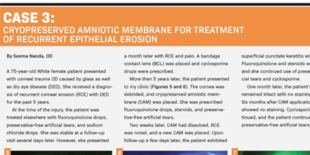 Guideline Redefines Amniotic Membrane’s Role In Ocular Surface Disease By: Douglas K. Devries, OD, Paul M. Karpecki, OD, FAAO, Seema Nanda, OD

Optometry Times Journal, October digital edition 2021

Follow Link: ow.ly/1gzp50HhHrE

<a href="/OptometryTimes/">Optometry Times</a> 

#IntrepidEyeSociety