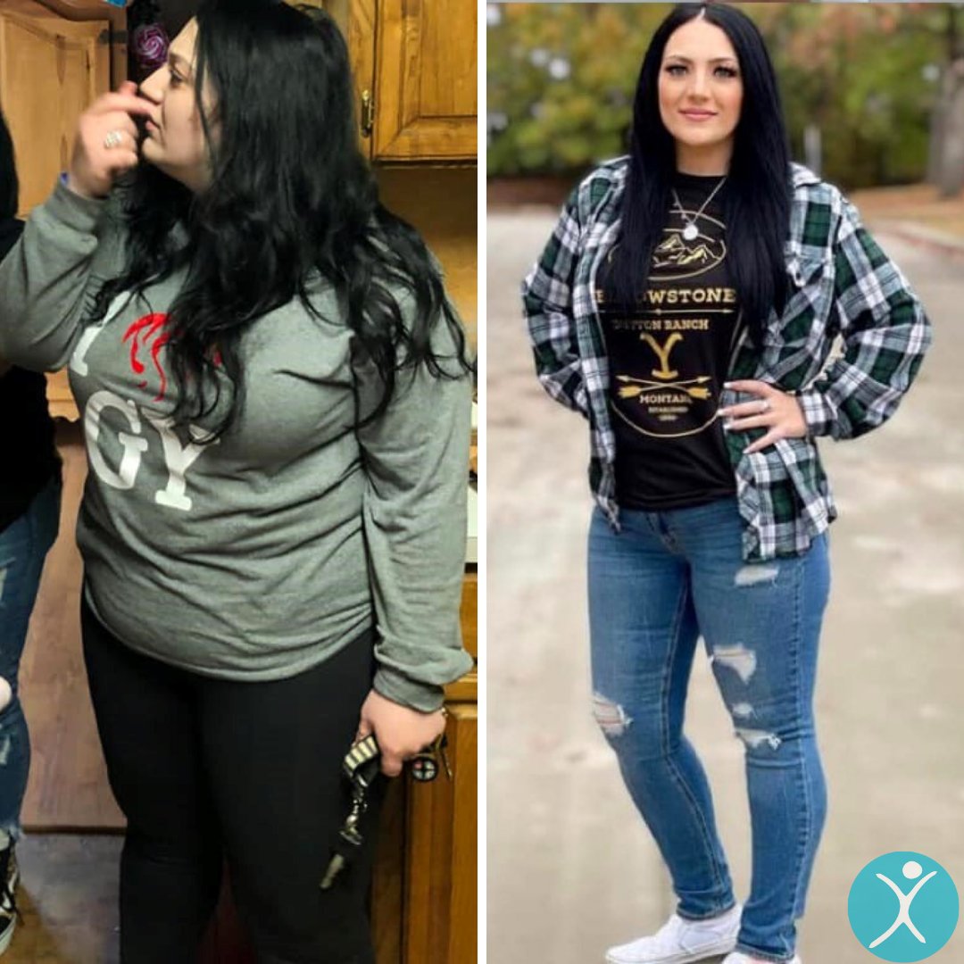 MexicoBariatric's tweet image. "I can’t even begin to tell you the mental, emotional, and even spiritual changes I’ve been blessed with aside from the physical changes while on this journey. Hands down the best decision I could have made. Getting my life back feels good. " - Kayla

#mbc #minibypass